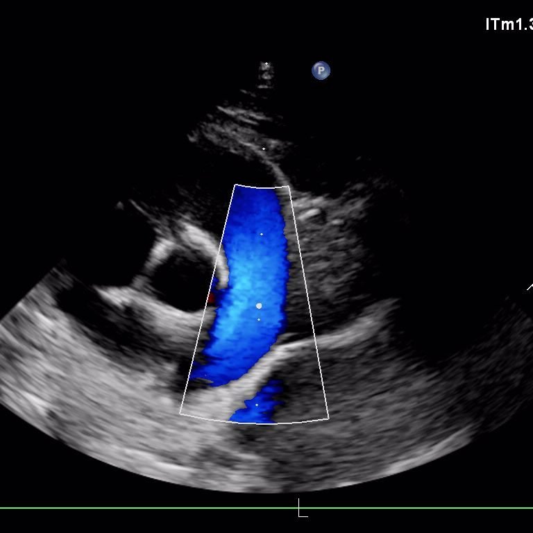 Echographie doppler 2